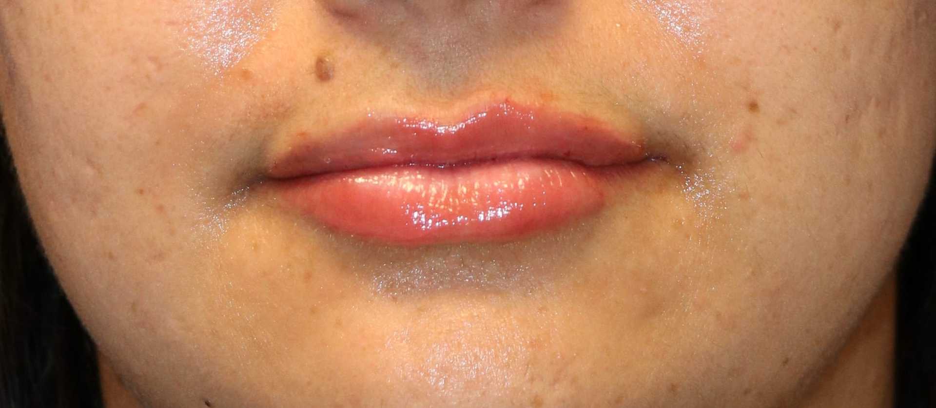 Lip filler atural look